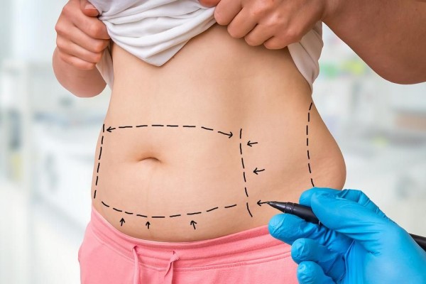 7 coisas que você precisa saber antes de realizar a sua lipoaspiração!