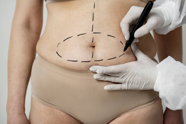 Abdominoplastia: Tudo o que Você Precisa Saber sobre o Procedimento, Recuperação e Custos